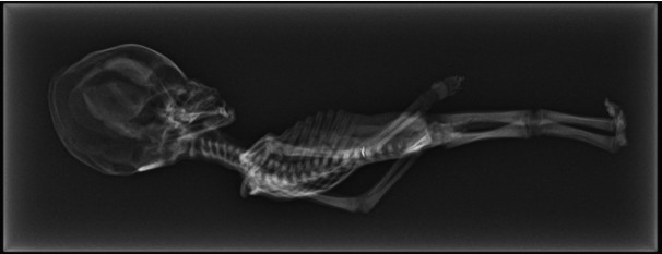 Atacama Alien - ‘Ata’s’ X-Rays