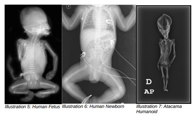 Human X-Ray comparison of ‘Ata’s’ X-Ray