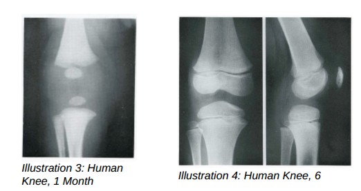 Knee comparison of ‘Ata’s’ X-Rays